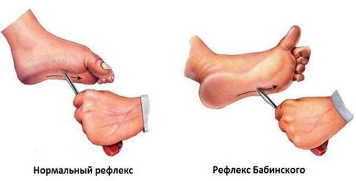 https://tonometr58.ru/wp-content/uploads/refleks-babinskogo.jpg