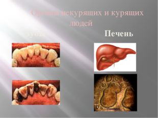  Органы некурящих и курящих людей Зубы Печень 