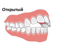http://zub4.ru/wp-content/uploads/2017/11/nepravilnyiy-prikus-e1513068709366.png