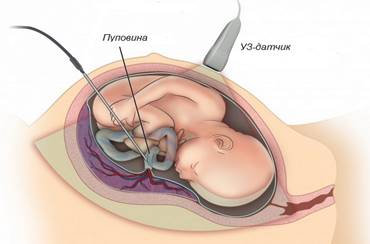 umbilical-transfusion.jpg