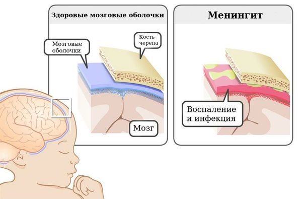 Менингит у детей