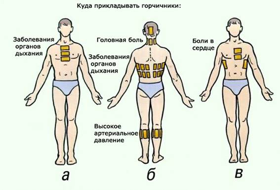 Можно ли самостоятельно высвободить зажатый нерв?