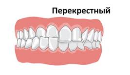 http://zub4.ru/wp-content/uploads/2017/11/nepravilnyiy-prikus-e1513068709366.png