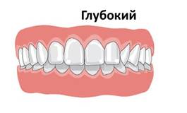 http://zub4.ru/wp-content/uploads/2017/11/nepravilnyiy-prikus-e1513068709366.png