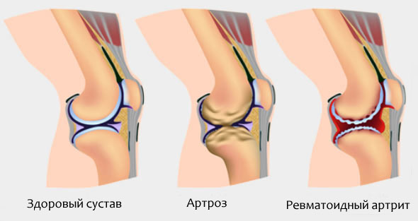 ревматоидный артрит суставов