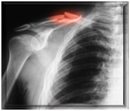 https://media.istockphoto.com/photos/xray-image-of-clavicle-fracture-ap-view-picture-id488093254?k=20&m=488093254&s=612x612&w=0&h=mZuKpEdiFpdbMXxds_0DJ1e5qEFsmbXfiWMJ4fCUvYc=