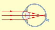 Схема хода лучей в глазу человека соответствует случаю дальнозоркости глаза без очков
