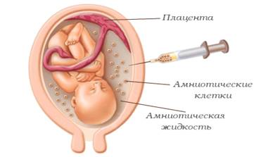 amniocentez-analiz-okoloplodnyh-vod.jpg