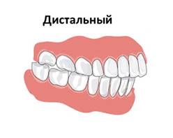 http://zub4.ru/wp-content/uploads/2017/11/nepravilnyiy-prikus-e1513068709366.png