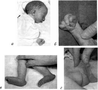 : а — новорожденный с синдромом Эдвардса