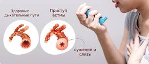 https://vlpravda.ru/wp-content/uploads/2022/12/asthma-bronchus.jpg