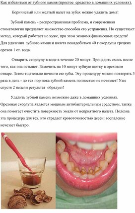 Как избавиться от зубного камня (простое  средство в домашних условиях).