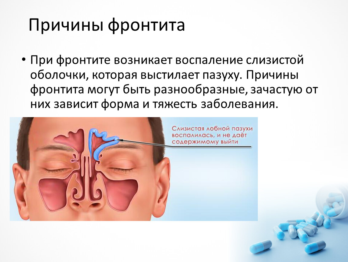 Затяжное заложенность носа. Синусит гайморит фронтит. Острый фронтит симптомы. Причины заболевания гайморитом и фронтитом.