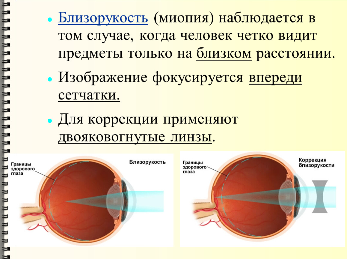 Где возникает изображение при близорукости