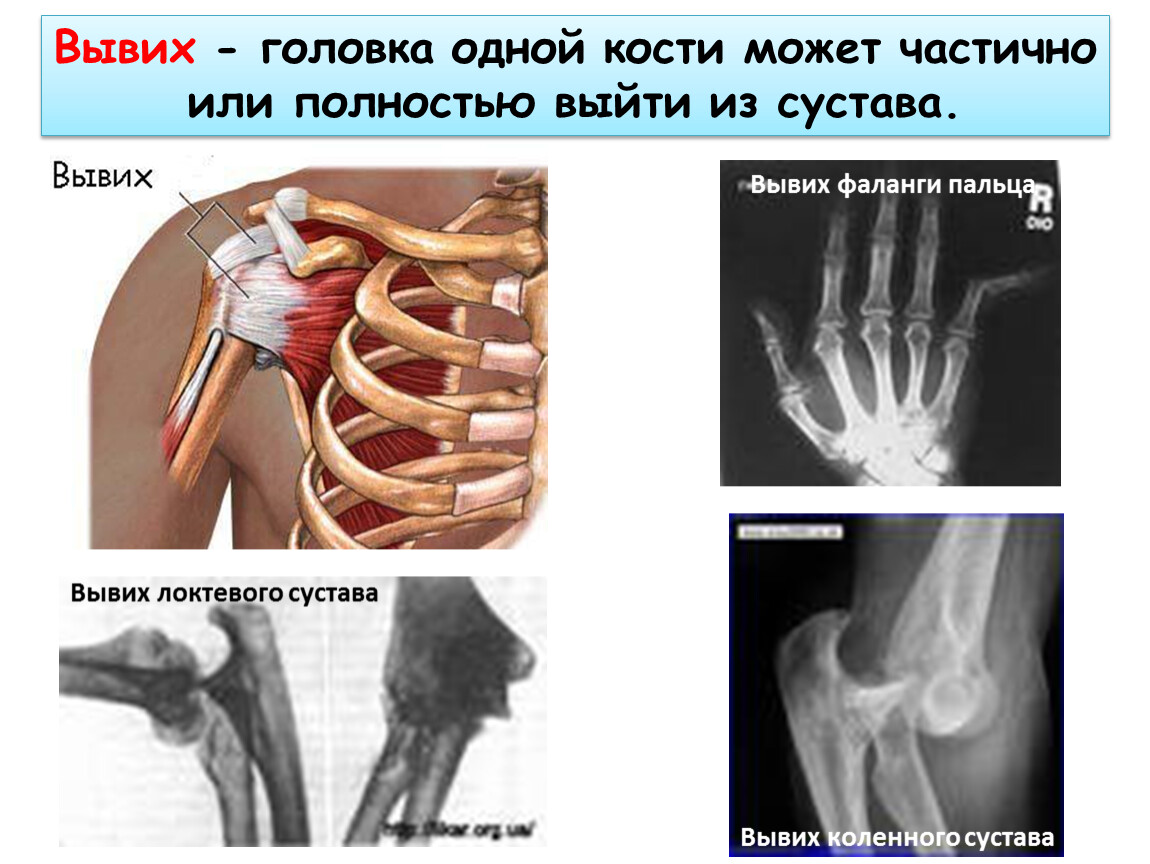 Картинка вывиха сустава