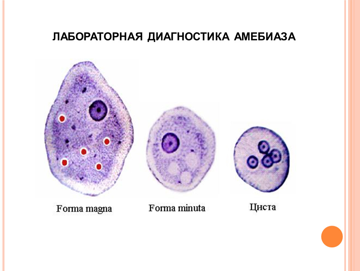 Клиническая картина амебиаза