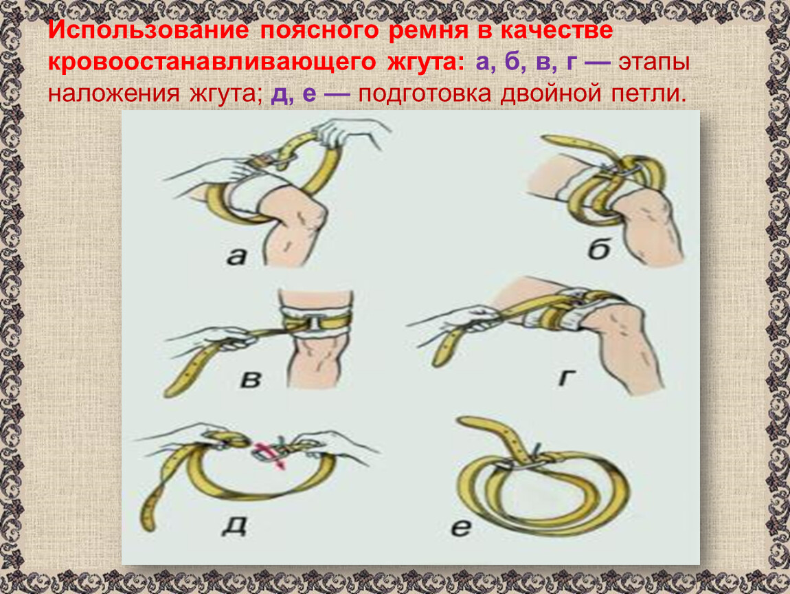 Кровоостанавливающий жгут время максимальное. Наложение кровоостанавливающего жгута. Ремня в качестве кровоостанавливающего жгута. Использование поясного ремня в качестве кровоостанавливающего жгута. Этапы наложения кровоостанавливающего жгута.