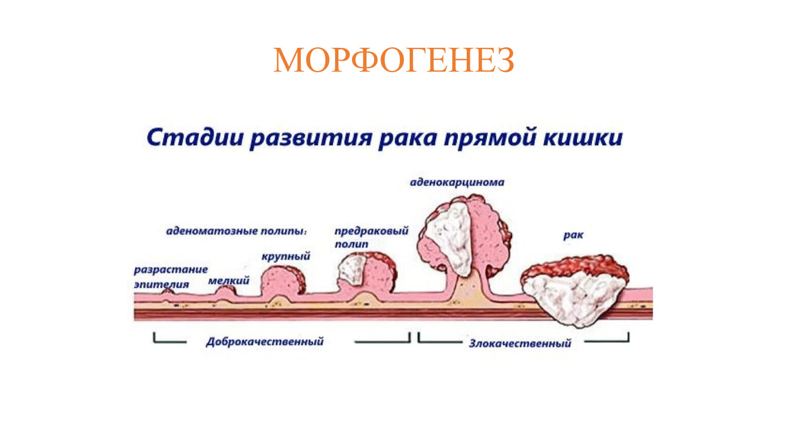 Морфогенез опухоли. Морфогенез. Стадии морфогенеза. Стадии морфогенеза гранулемы. Процессы морфогенеза.