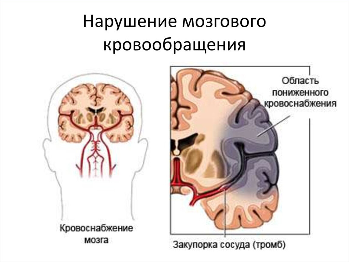 Вид нарушения кровообращения картинки