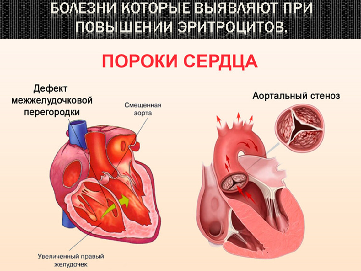 Порог сердца что это. Врожденныепопроки сердца. Пороки сердца:пороки сердца.
