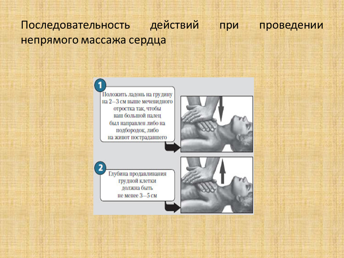 Последовательность проведения непрямого массажа сердца. Порядок действий при проведении непрямого массажа сердца. Последовательность действий при проведении непрямого массажа. Порядок проведения непрямого массажа сердца. Последовательность непрямого массажа сердца.