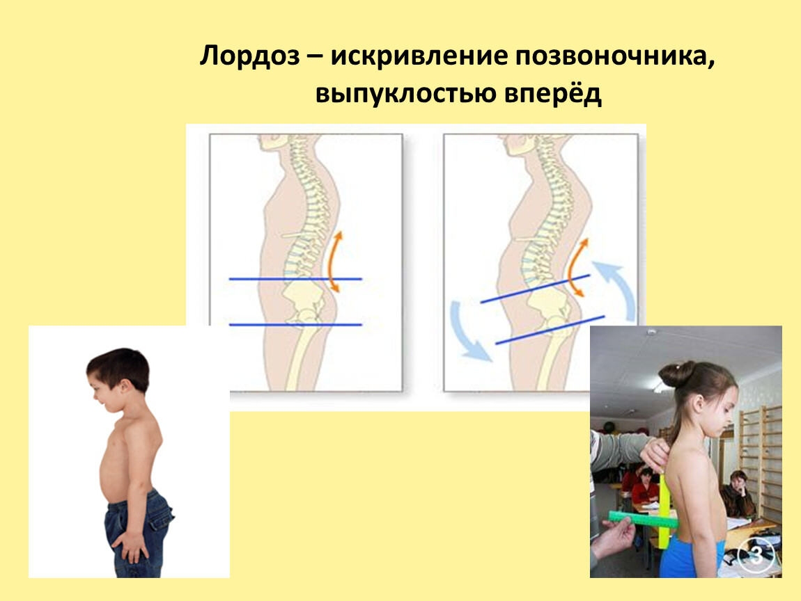 Лордоз позвоночника. Искривление позвоночника лордоз. Лордоз искривления позвоночника и причины. Лордоз позвоночника у детей. Лордоз это искривление позвоночника вперед.