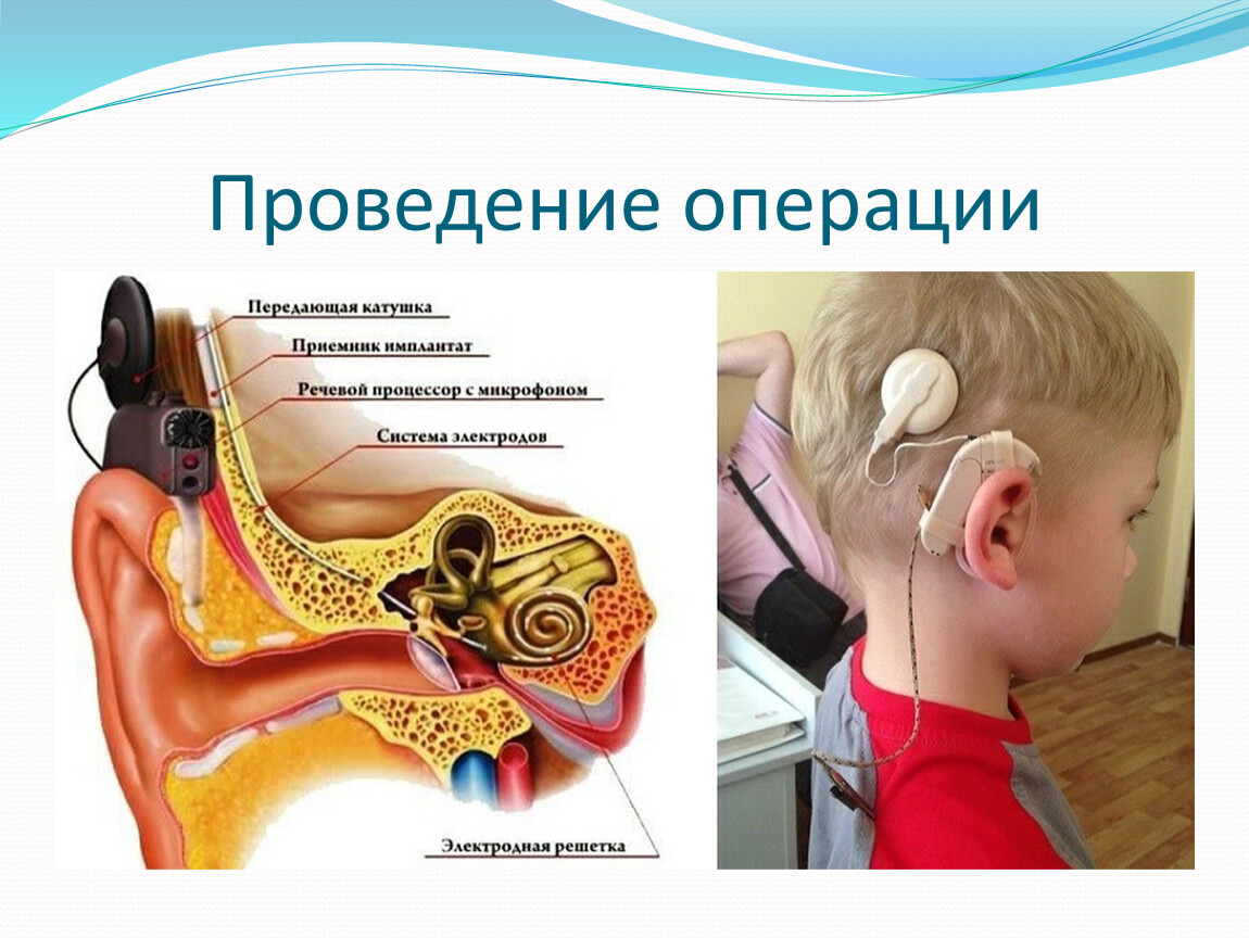Шунты в уши ребенку. Кохлеарная имплантация операция. Грэм Кларк кохлеарная имплантация. Слуховой аппарат кохлеарный имплант. Аппарат для глухих кохлеарная имплантация.