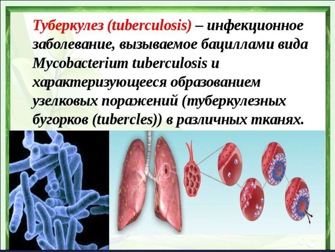 Ru туберкулез