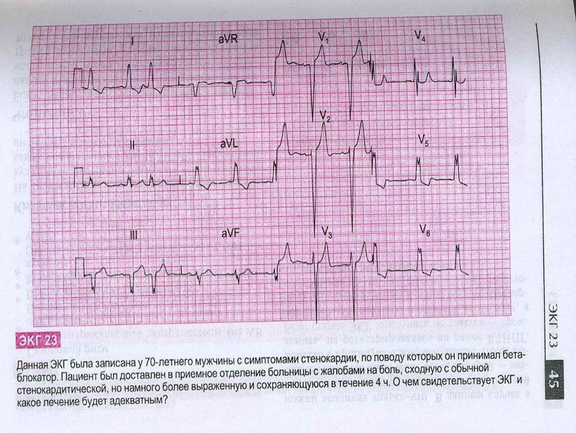 Экг в московский. Вазоспастическая стенокардия ЭКГ. Стабильная стенокардия напряжения ЭКГ. ЭКГ при стабильной стенокардии. ЭКГ при ИБС стенокардия напряжения 2 ФК.