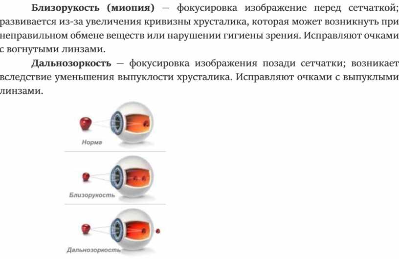 Если изображение фокусируется перед сетчаткой глаза возникает