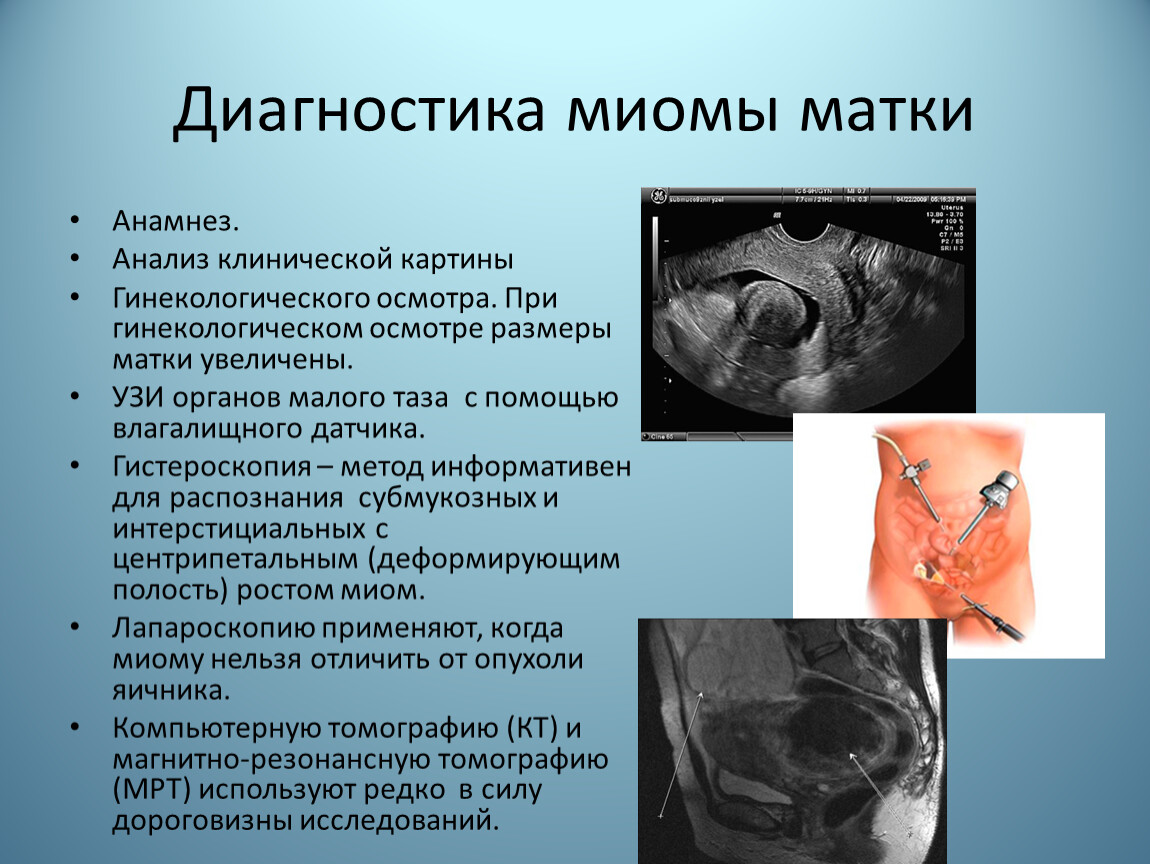 Презентация на тему "Миома матки как одна из причин бесплодия". Автор ...