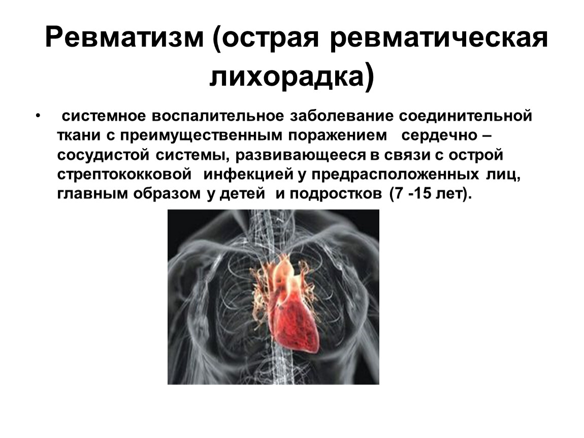 Ревматизм (острая ревматическая лихорадка) системное воспалительное заболевание соединительной ткани с преимущественным поражением сердечно – сосудистой системы, развивающееся в связи с острой стрептококковой инфекцией у предрасположенных…