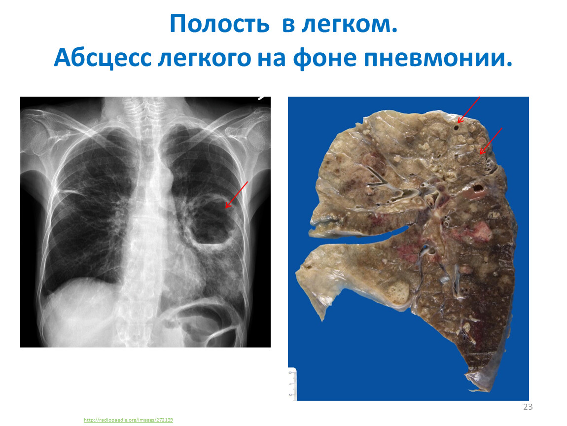 Абсцесс легкого картинки