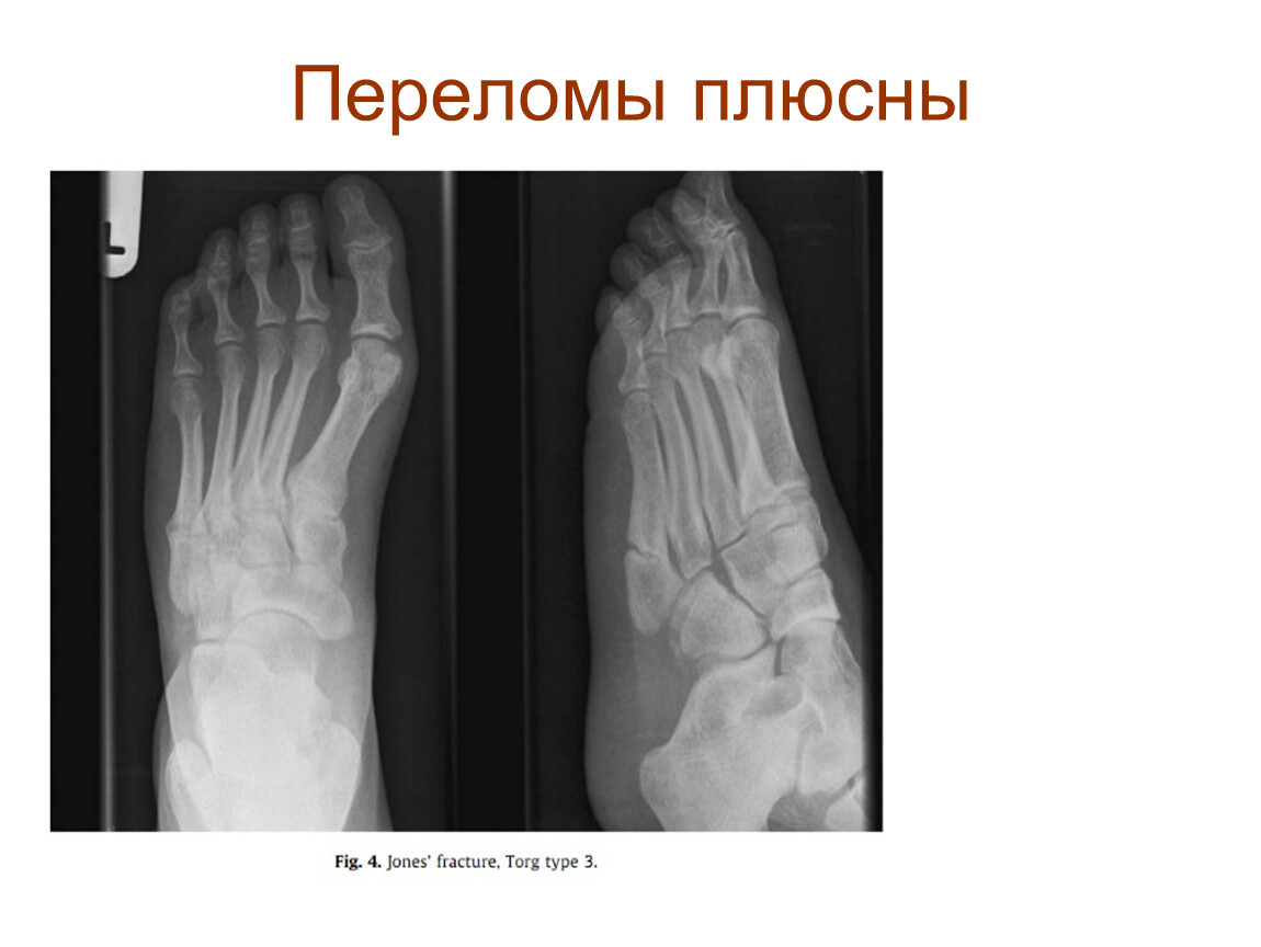 Перелом ноги 5 кости. Кости предплюсны стопы перелом. Перелом кости плюсны рентген. Перелом костей предплюсны стопы.
