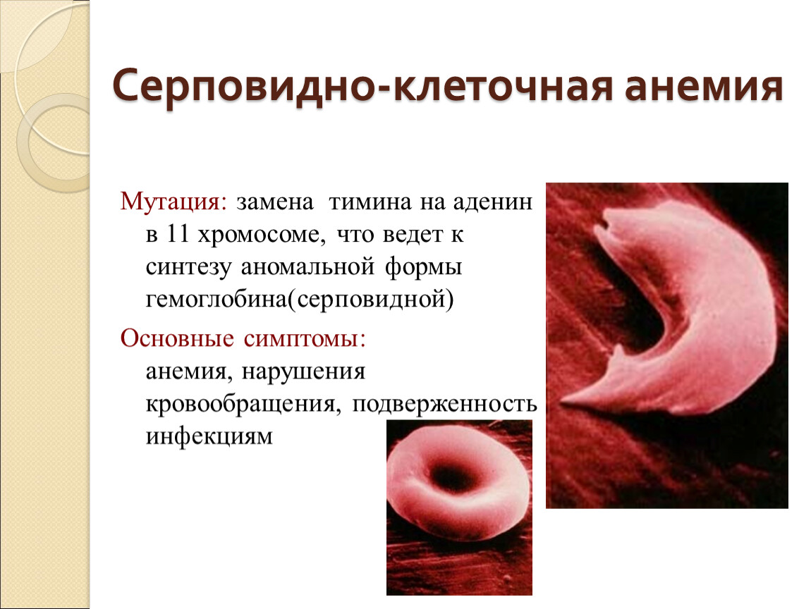 Серповидно клеточная анемия. Гемоглобин серповидноклеточная анемия. Серповидно клеточная анемия клиника. Серповидноклеточная анемия мутация. Серповидноклеточная анемия диагностика генетика.