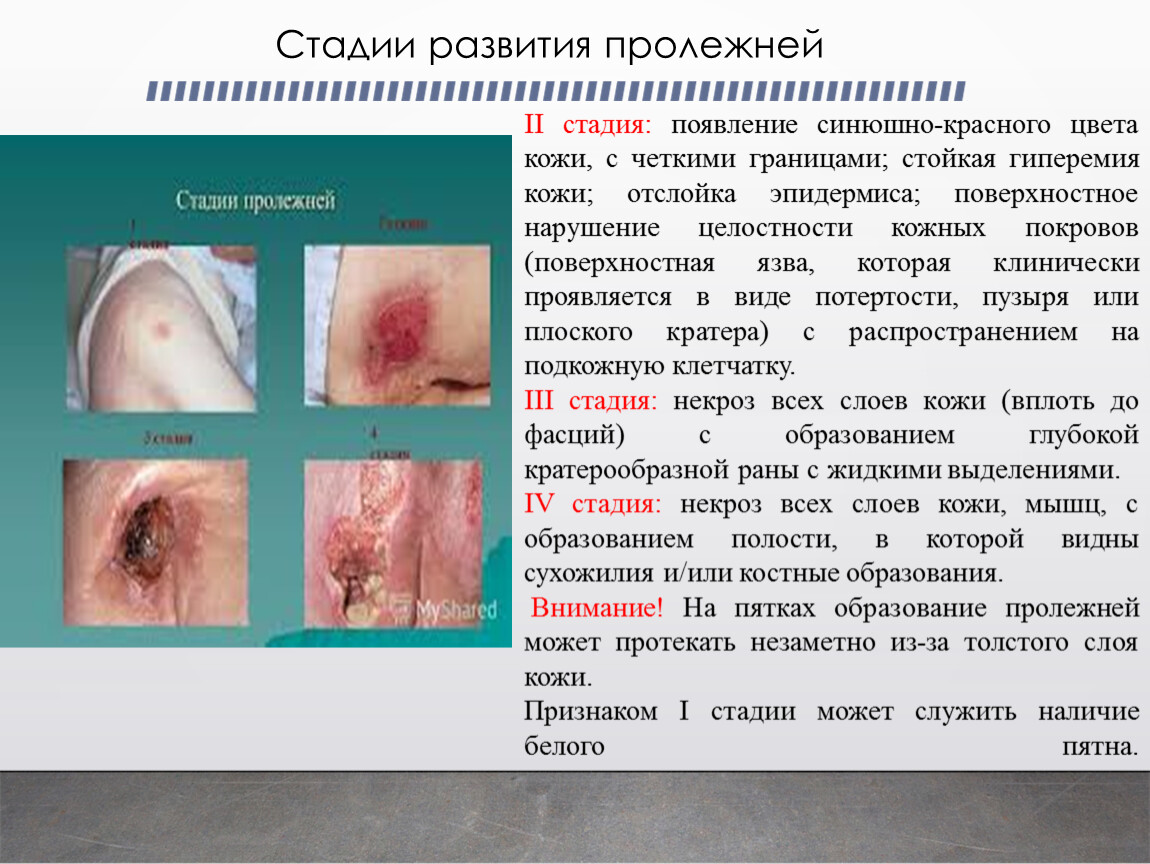 Профилактика пролежней