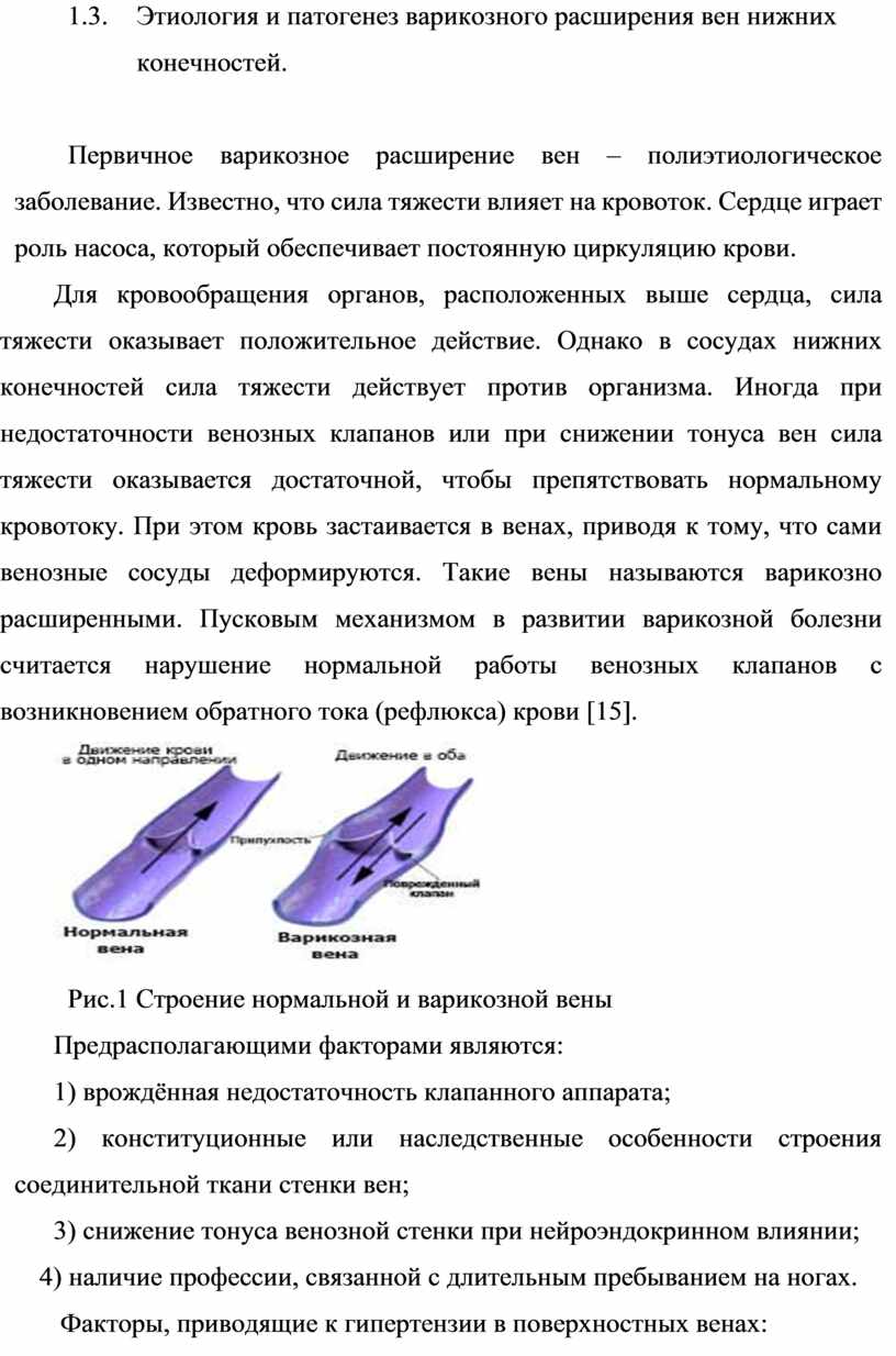 Патогенез варикозной болезни