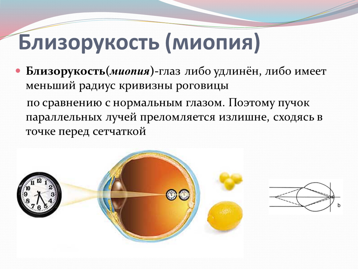 Дефекты зрения физика презентация