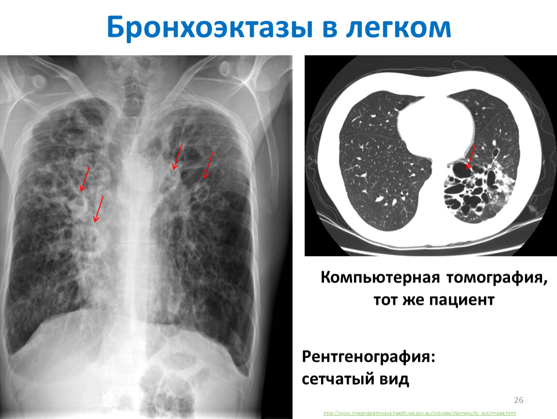 Кт картина бронхоэктазов