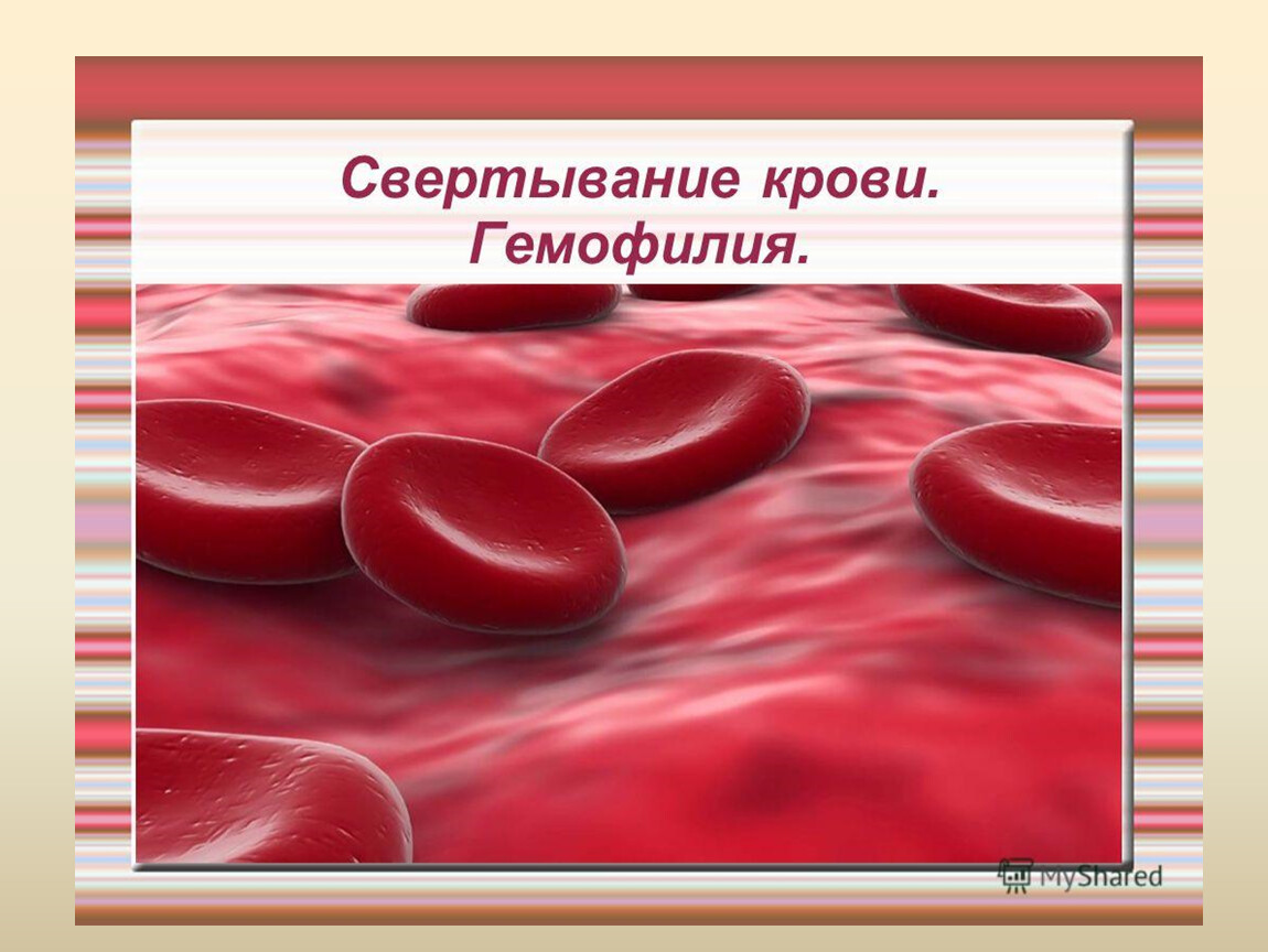 Гематофилия. Наследственные заболевания крови. Гемофилия свертывание крови. Свертываемость крови гемофилия.