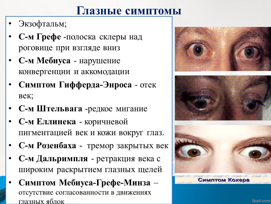 Экзофтальм наблюдается при. Глазные симптомы экзофтальм Грефе Мебиуса Штельвага. Симптом кохера глазной.
