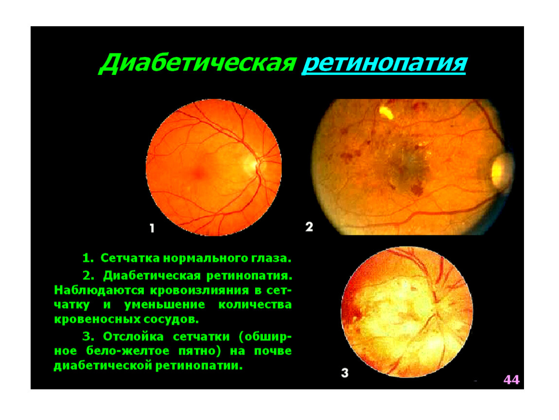 Диабетическая ретинопатия