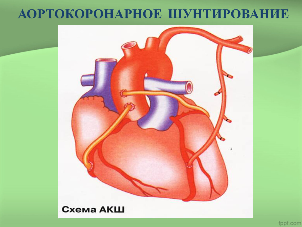 Что такое шунтирование сердца и сосудов. Аорто-коронарное шунтирование. Схема операции аортокоронарного шунтирования. Порто коронарное шунтирование. Аорто копонарное шунтирование.