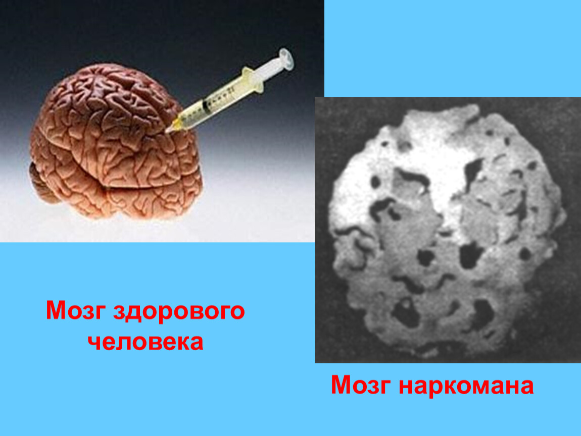 Мозг алкоголика и здорового человека картинки