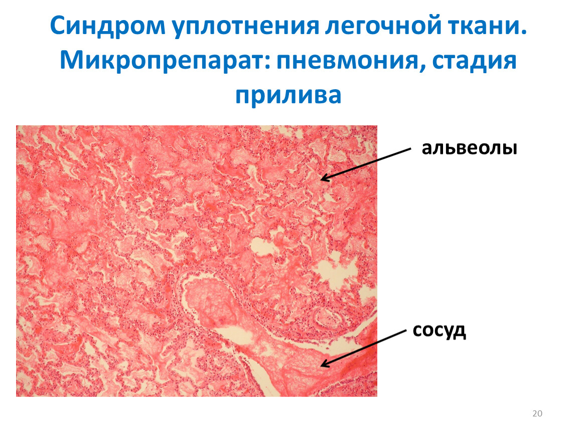 Очаговая пневмония рисунок микропрепарат