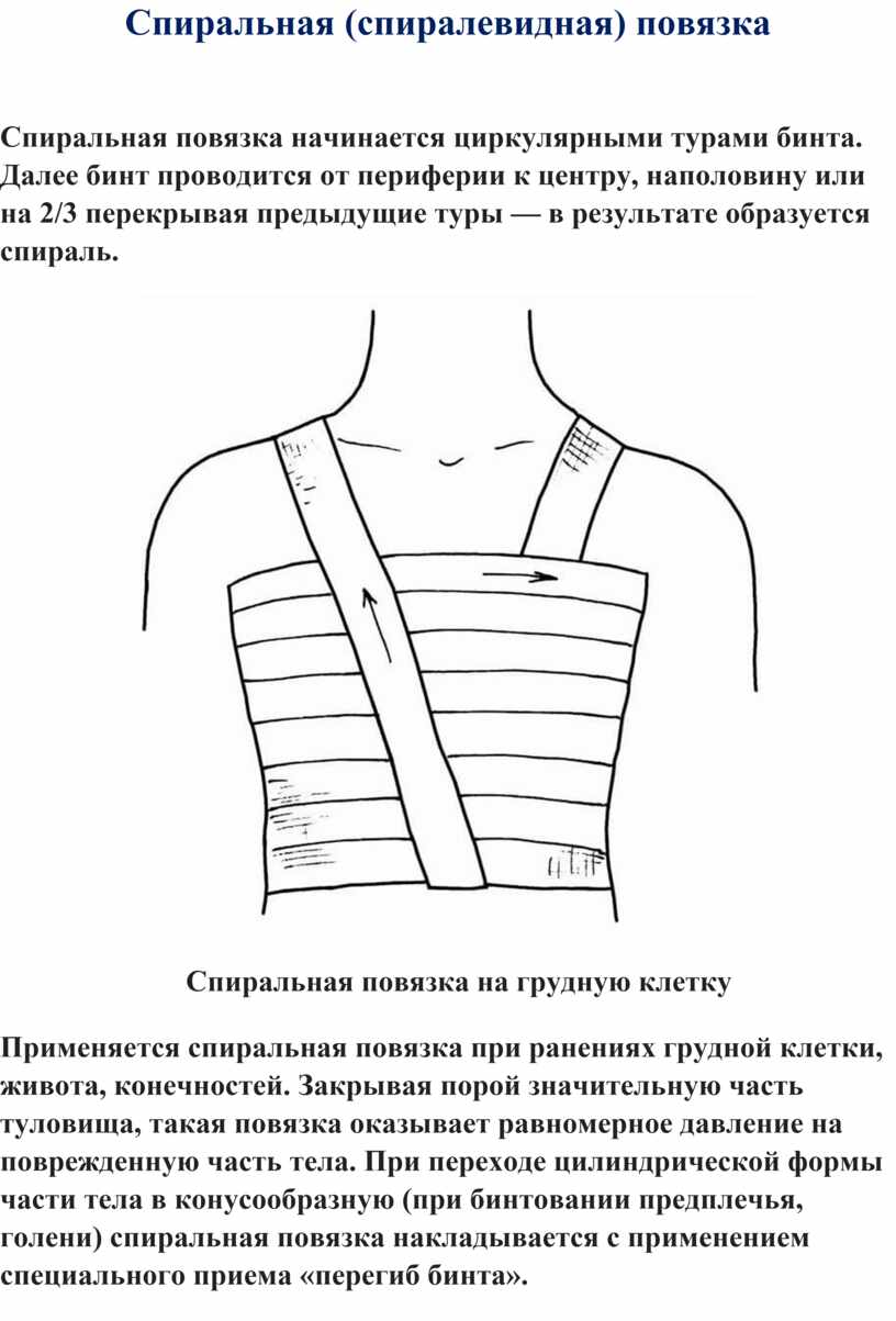 Спиральная (спиралевидная) повязка