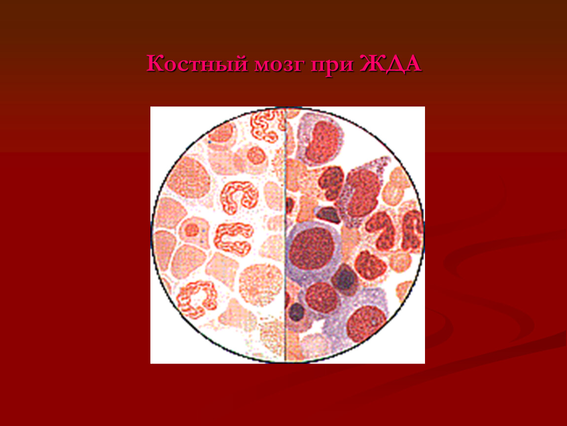 Результаты костного мозга. Костный мозг при железодефицитной анемии. Костный мозг при в12 дефицитной анемии. Изменения костного мозга при железодефицитной анемии.