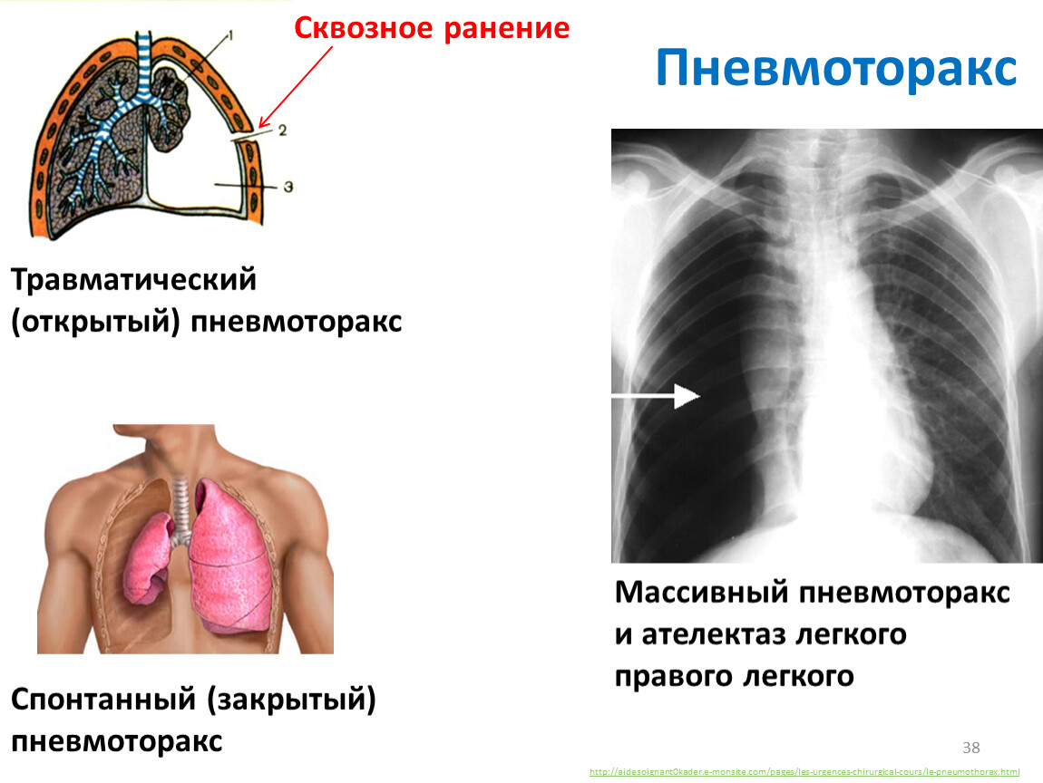 Что такое пневмоторакс. Тотальный левосторонний пневмоторакс. Травматический открытый пневмоторакс. Пневмоторакс легких травматический. Легочные осложнения пневмонии пневмоторакс.