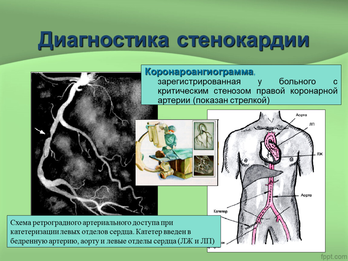 Стенокардия картинки для презентации