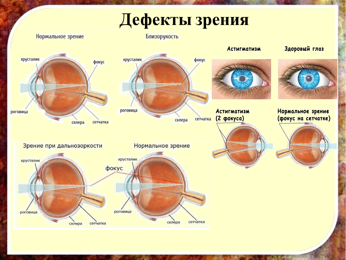 Глаз очки дальнозоркость и близорукость. Дефекты зрения близорукость и дальнозоркость. Аномалии рефракции глаза близорукость дальнозоркость таблица. Таблица заболевания глаз близорукость и дальнозоркость. Дефекты зрения картинки.